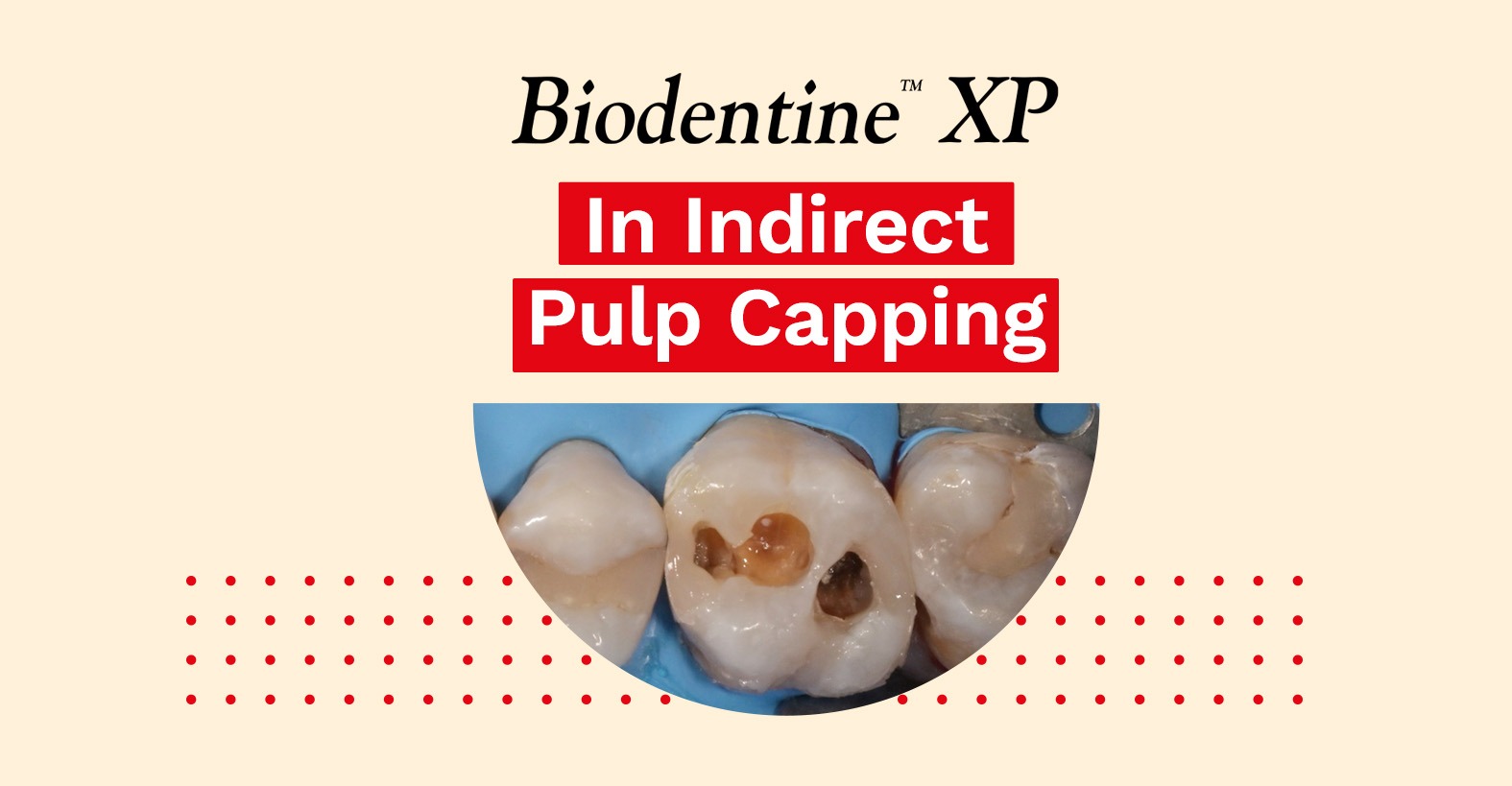 Indirect Pulp Capping - Dr Ganowicz - Septodont IN